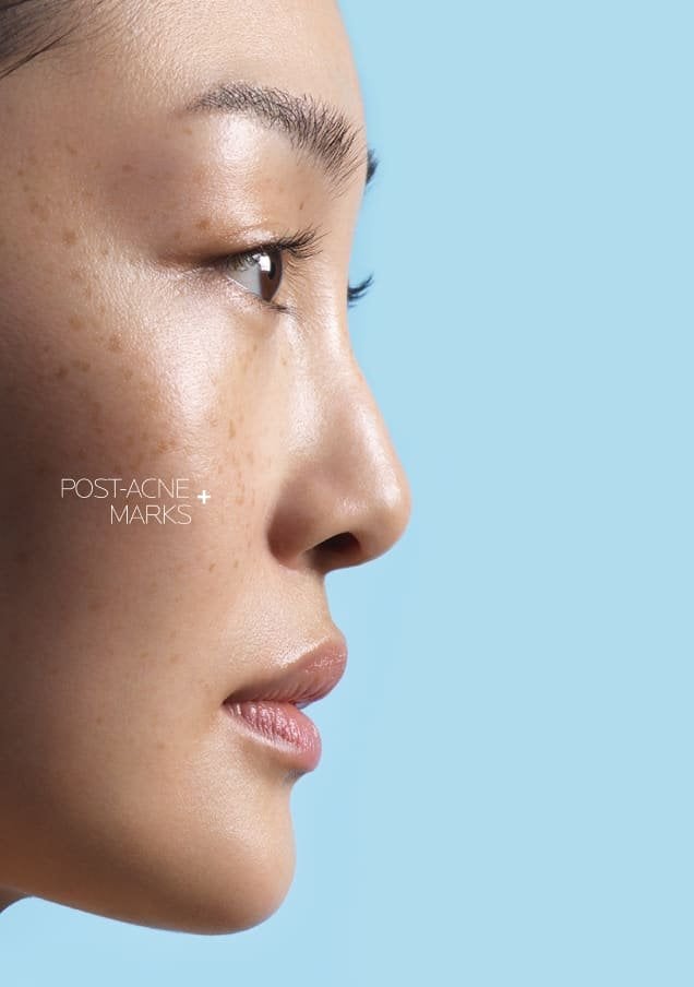 /-/media/project/loreal/brand-sites/lrp/master/dmi/products/effaclar/effaclar-a-z-gel-cream/desktop/lrp-effaclar_azcream_flip_card_front_desktop_3.jpg
